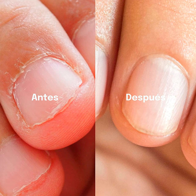 unas-mordidas-esmalte-ortoprime