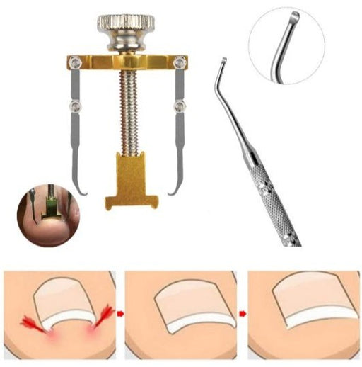 kit-de-correccion-de-unas-ortoprime